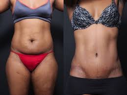 When Can You Have A Tummy Tuck After C Section Pin On Ps