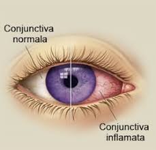 Simptomele bolii pot varia, în funcție. Conjunctivita Sau Ochiul RoÈu Jurnal Spiritual