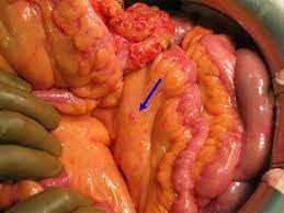 When cancerous tumors form on connective tissues, it is a sarcoma. Hipec Mesothelioma