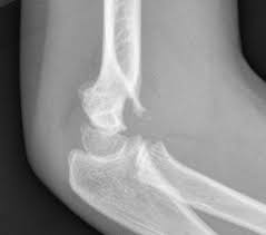 Http Www Pedworld Ch Entree Orthopedie Traumatologie Protocoles 2010 Vademecumfinal Orthopedique 20 Hel Pdf