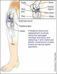 Bilateral Knee Replacement Surgery Best Thing I Ever Did Because It Gave Me My Life Knee Replacement Recovery Knee Replacement Exercises Knee Surgery Recovery