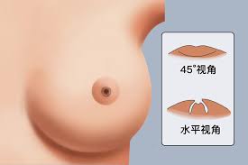 乳头内陷严重图示
