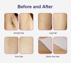 Full brazilian after 4th treatment, the hair is 80% gone. 2021 Best 808nm Diode Laser Hair Removal Machine Review Permanent Hair Removal Cream China Sex Hair Remover Electric Hair Remover Made In China Com