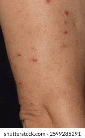 Image result for Neurotic Excoriation