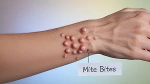 Image result for mite bites on humans