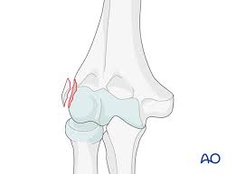 Image result for Lateral Condyle Fracture