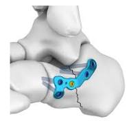 Itval Oblique L-shape Locking Plate,Medical Device ...