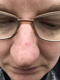 Cells that give the skin its tan or brown color are called melanocytes. Does This Look Like Basal Cell On My Nose Mumsnet