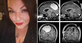 Mum discovers new symptoms of her migraines were a massive brain tumour
