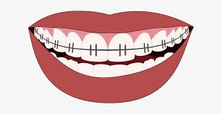 Falling leaves transparent gifs, reaction gifs, cat gifs, and so much more. Orthodontics Smile Teeth Dentist Mouth Braces Transparent Background Clipart 612x340 Png Download Pngkit