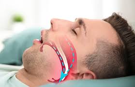 Image result for Sleep Apnea