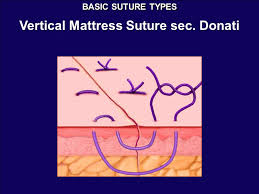 We did not find results for: Basic And Special Suturing Techniques Ppt Video Online Download