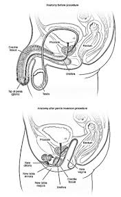 Transgender Surgery Transgender People Andromedic Academy