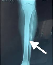 Image result for Osteomyelitis