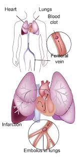 A pulmonary embolism (pe) happens when a blood clot gets caught in an artery in the lungs. Pulmonary Embolism Pe Conditions And Treatments La Vascular Endovascular Surgery