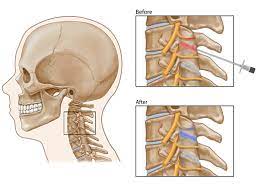 Cervical Facet Joint Injection Chronic Neck Pain Treatment Pain Spa Bristol Uk