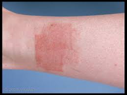 Determining If You Have A Nickel Allergy Sutton Dermatology Aesthetics Ctr