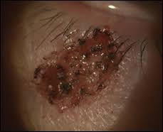 Where the mole has been entangled with shave biopsy is done on elevated moles. Suspicious Growing Lesion On Lower Lid
