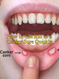 Image result for Canker sores symptoms roof of the mouth