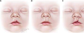 Image result for Cleft Lip
