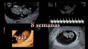 Ecografia 2d Embarazo De 8 Semanas Embrion Moviendose Clinica Ginecologica Dr Rafael Ortega Munoz Youtube