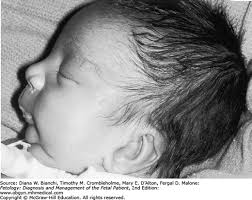 Image result for Micrognathia