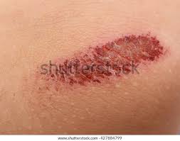 Abrasion On Skin Stock Photo (Edit Now) 427884799