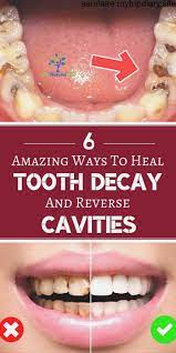 Maybe you would like to learn more about one of these? How To Reverse Tooth Decay Toddlers Arxiusarquitectura