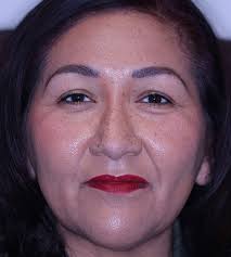 ColorEyes™ Keratopigmentation Los Angeles & Beverly Hills CA