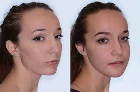 Nose Before And After Upper Jaw Surgery 9 Liposuction Before And After Jaw Surgery Lipo Before And After Jaw