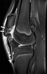 Check spelling or type a new query. Layered Approach To The Anterior Knee Normal Anatomy And Disorders Associated With Anterior Knee Pain Radiographics