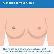 How breast cancer is diagnosed. Breast Cancer Health Information Bupa Uk