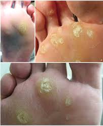 See full list on wikihow.com Verruca Treatment Home