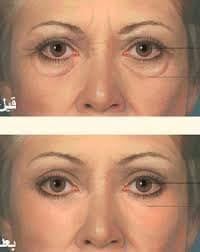 ما هي عملية تجميل الأجفان عملية تجميل الاجفان (Eyelid blepharoplasty) هي عملية جراحية تتم لغرض تحسين مظهر جفني العين، ويمكن إجراء هذه الجراحة إما لتجميل وشد الجفون العلوية، أو لشد الجفون السفلية