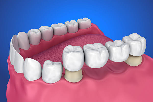 Options for the Replacement of Multiple Missing Teeth