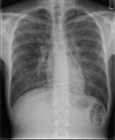 Les légionelles sont des bactéries intracellulaires. Pneumonie