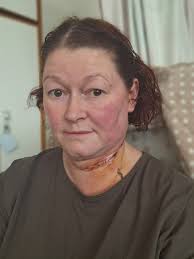 This is me. Currently living my best life (not) as I await the Ambulance  crew to help me up off the floor... Really wish my lungs weren't slowly  filling up with fluid.