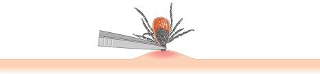 Image result for Tick Removal