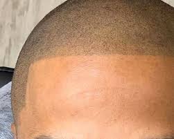 The goal of smp isn't to create hairlike lines as you would when microblading eyebrows, but instead to use tiny, layered dots in different hues . Scalp Micropigmentation Vs Tricopigmentation Medical Tattoo Centers Of America