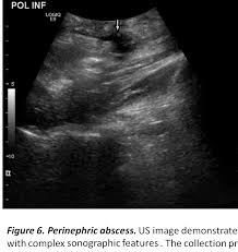 Image result for Perinephric Abscess