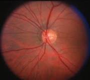 Image result for what causes the optic nerve to enlarge treatment