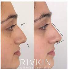 Let's talk about the basics. Westside Aesthetics Non Surgical Nose Job Nose Job Nose Fillers Rhinoplasty Nose Jobs