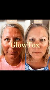 One of my 𝐅𝐀𝐕𝐎𝐑𝐈𝐓𝐄 𝐓𝐑𝐄𝐀𝐓𝐌𝐄𝐍𝐓𝐒.....ⒼⓁⓄⓌⓉⓄⓍ! , GlowTox is  when you combine Neurotoxin and Chemical Peel. Here at 𝐆𝐥𝐨𝐰 𝐒𝐤𝐢𝐧  𝐋𝐚𝐛 we combine your neurotoxin of choice with our VI Chemical Peel  brand! , 𝚃𝚑𝚎 ...