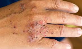 Image result for contact dermatitis