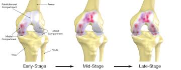 Hasil gambar untuk Bab 2 Osteoarthritis