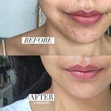 20 G Mederma Gel Remove Scars Treatment Burn Keloid Acne Scar For Sale Online Ebay