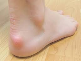Insertional achilles tendinitis and haglund's deformity. Osteopathy Massage And Acupuncture For Heel Pain Osteopathy In Hatfield