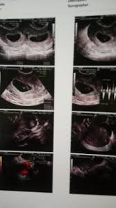 Fiz Uma Ultra Vaginal Com 7 Semanas E 3 Dias Maio De 2020 Babycenter