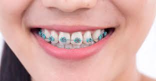 4.4 out of 5 stars. What Should You Do If A Bracket Or Wire Breaks On Your Braces Weston Dental Office