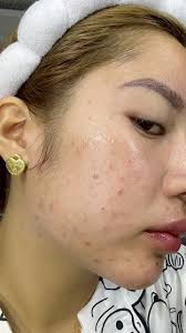 Akala ko hindi na mawawala mga tigyawat ko, Salamat talaga sa product nato  😭🤍